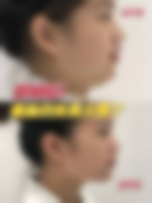 瘦脸针有抗体没成效的破局之法常见并发症或后遗问题，在临床中如何理解其发生概率？