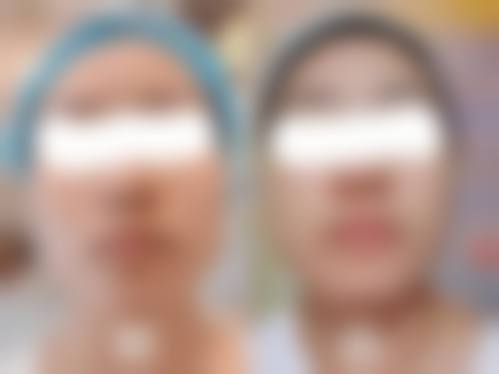 圆脸打完瘦脸针的成效，这些变化看得见