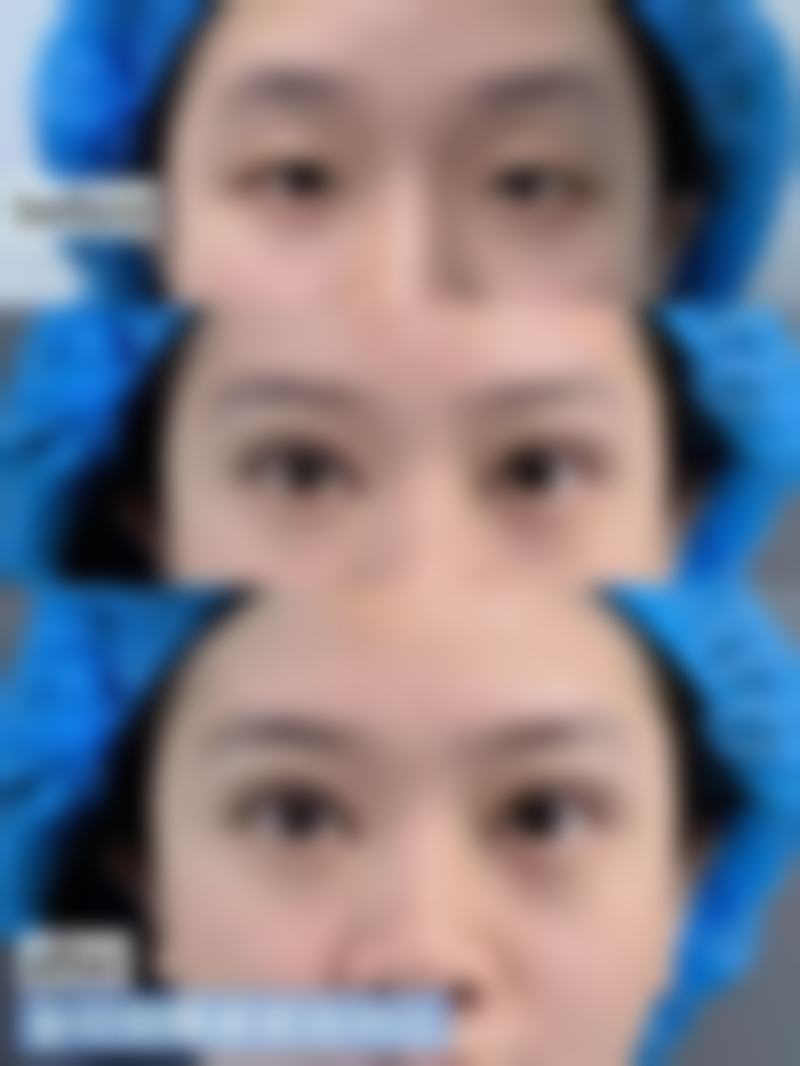切开法双眼皮手术的常见认知偏差与误解