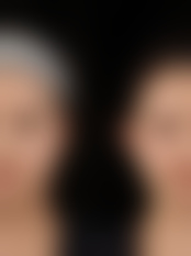 切开法双眼皮手术的价格区间及费用差异来源