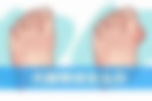 毛发种植的有哪些？FUE无痕植发创伤小、微针植发更精准、毛囊单位提取术效果好！微针单毛囊10-20元，成活率超90%