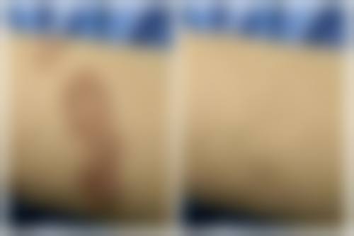 芦荟胶有没有淡化疤痕的效果？有！含多糖和氨基酸加速修复，还能抗炎舒缓疤痕！99%款比92%更优，浅表疤痕改善显著！