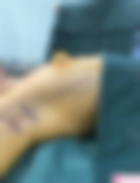 隆胸取出假体能恢复吗？能！术后3-6个月复原，护理要点+恢复周期全知道