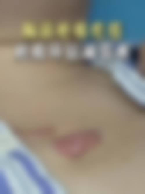 激光祛疤和手术修复祛疤是什么？通常在什么医学背景下被选择？