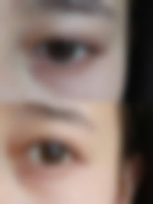 近视人群做双眼皮手术后成效如何？多数理想但有个别差异