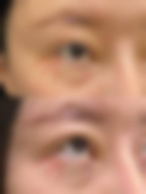 定位双眼皮线取出的优势有哪些？