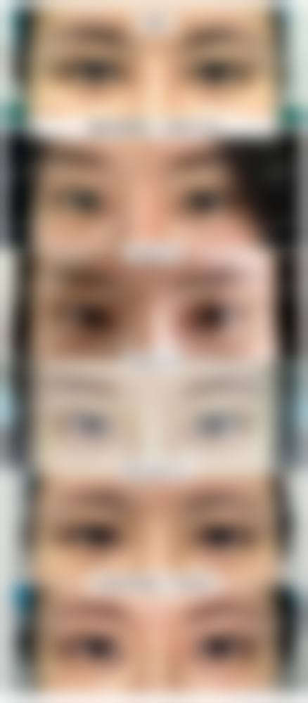 真人实例分享：怎么做能变双眼皮？