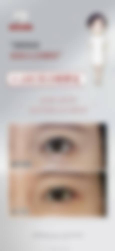 定位双眼皮取线后多久能修复？