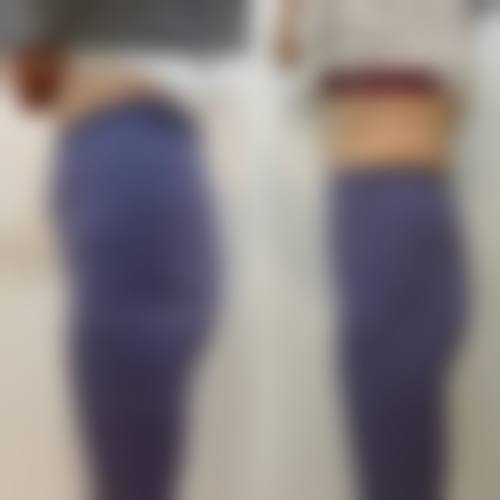 如何加快妈妈臀抽脂后的修复速度?