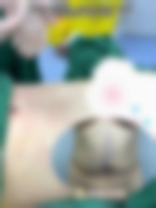 妈妈臀抽脂后多久能恢复？一般3-6个月能基本恢复，影响因素揭秘，附消肿时长+速复技巧