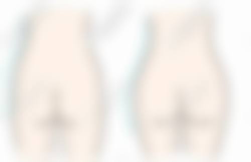 妈妈臀抽脂后多久会看到成效和消肿?