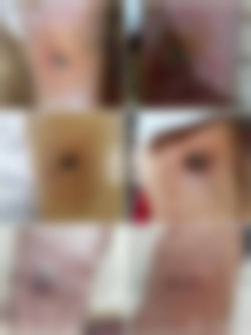 怎么样可以除凹陷疤痕？填充手术仅需3000元起、激光治疗温和有效，方法多样任你选！大学生战痘留疤，点阵激光联合填充治疗，凹凸脸逆袭平滑肌！ 