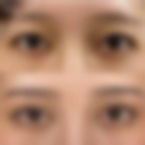 手术方法：如何让单眼皮变成双眼皮？