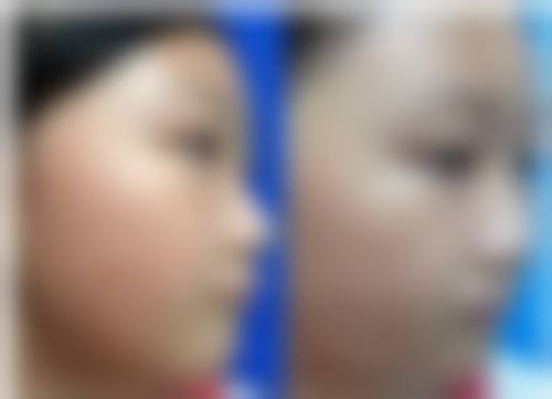 五、在实际操作中,疤痕疙瘩治疗更适合哪些人?