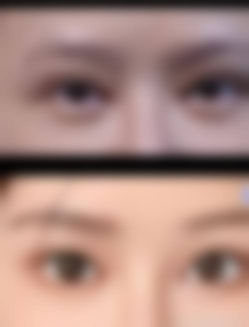 去眼袋是恒久的吗？是的！哪些人风险显著更高