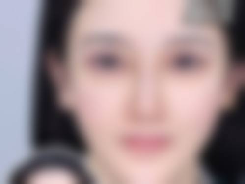 去眼袋是恒久的吗？是的！真实修复过程与不适时间线