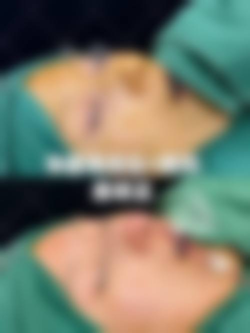 隆鼻部位多少与术后性生活时间有什么关联?