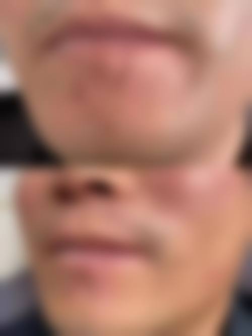 五、乌鲁木齐高丽汉白整形医院真实实例参考