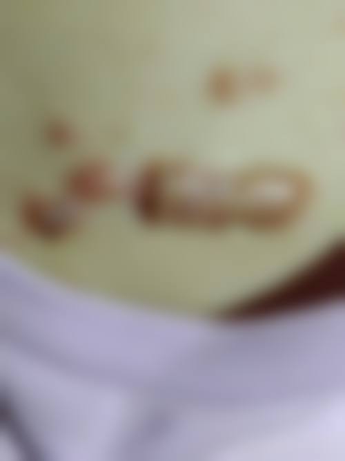 三、从医学角度看,疤痕疙瘩治疗的核心目的是什么?