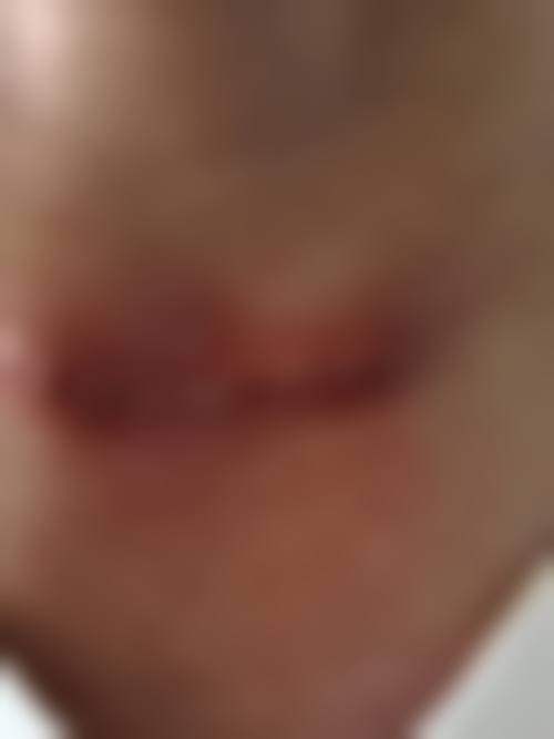 在决定是否选择按摩药物修复烧伤疤痕前，普通用户更容易忽略的关键评估点