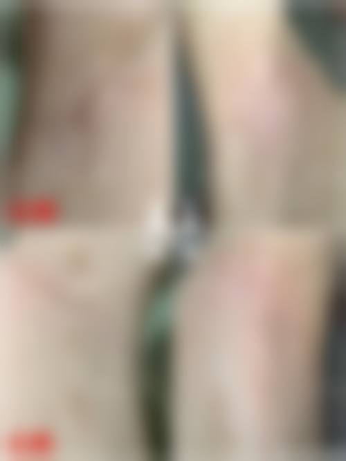 七、疤痕疙瘩治疗的费用为何差异明显?价格区间如何形成?