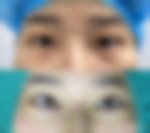 去眼袋是永久的吗？是的！手术切除/激光治疗选对方法，效果持久复发率低！