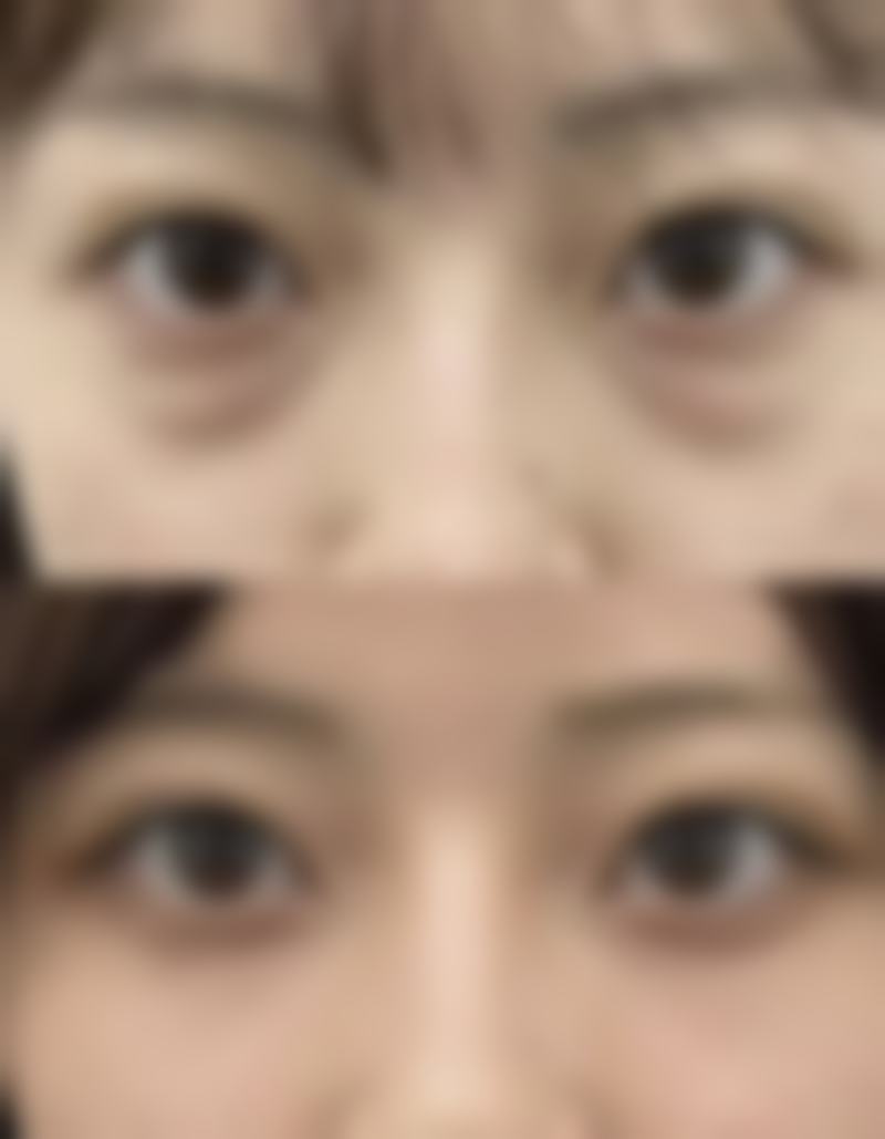 去眼袋是恒久的吗？是的！如果成效不理想，是否有补救与修复空间