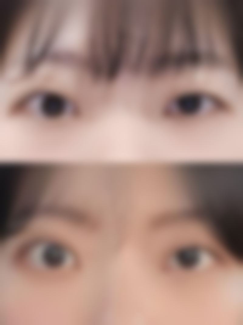 七、女性眼袋大怎么改善？调整作息+眼部按摩+医美手段，三管齐下超有效！的费用为何差异明显？价格区间如何形成？