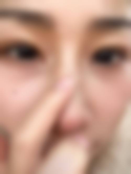 五、在实际操作中，疤痕体质开了眼角后淡化疤痕更适合哪些人？