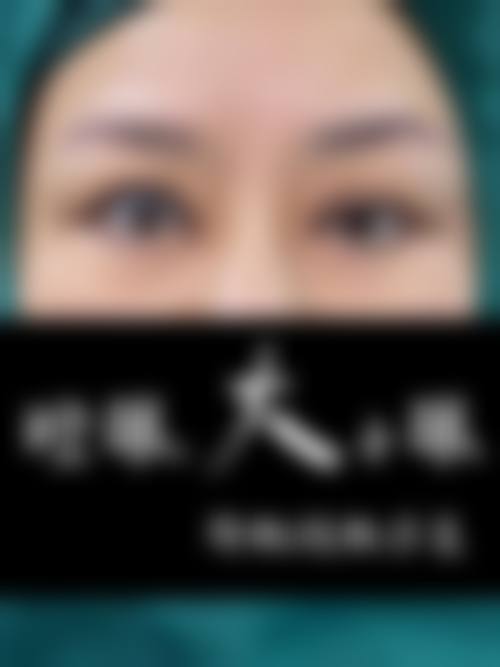 做一次眼袋手术能管多久？一般能维持5~10年，具体时长受这些因素影响！附2种术式、恢复周期