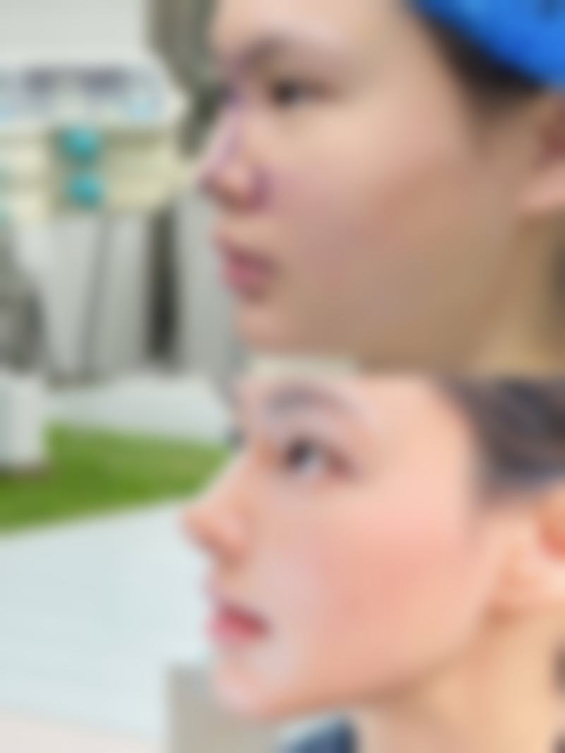 耳软骨隆鼻术后科学护理 + 饮酒过渡注意事项