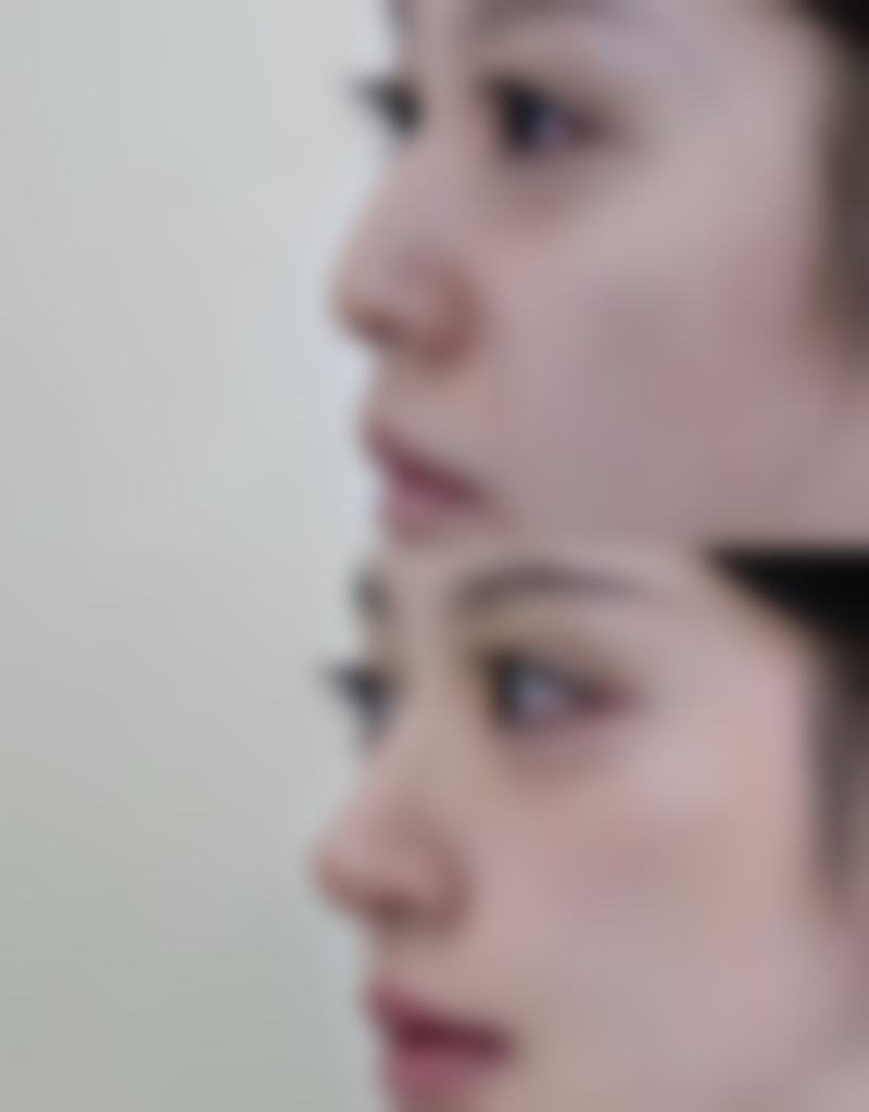 耳软骨隆鼻常见饮酒相关疑问解答