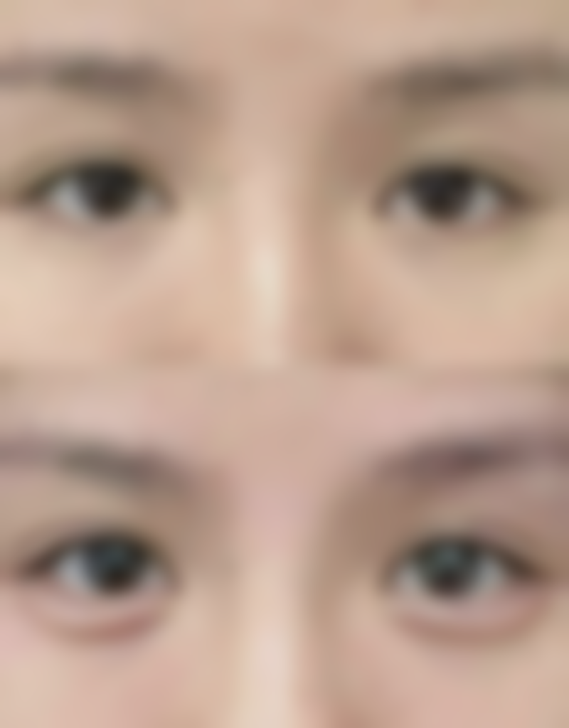 修正多效紧致修护眼霜与手术去眼袋对比如何？