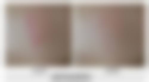 科学疗法修复黄斑疤痕的成效能维持多久