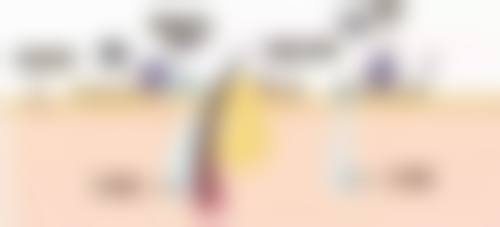 非手术缩小阴唇本身能解决什么、不能解决什么?