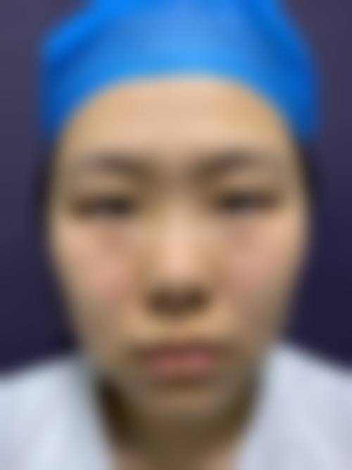 重度眼袋消除方法常见并发症或后遗问题，在临床中如何理解其发生概率？