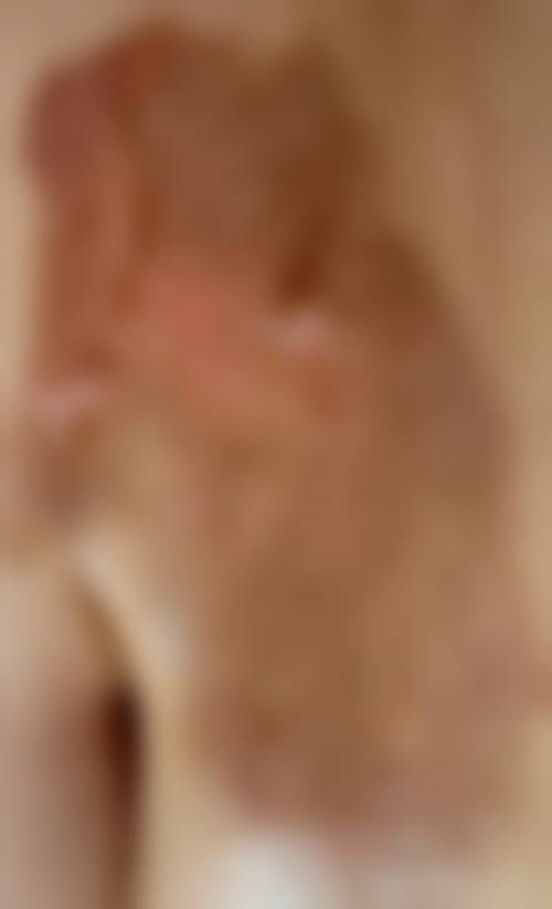 手术修复烫伤疤痕多少钱?心里有谱不踩坑