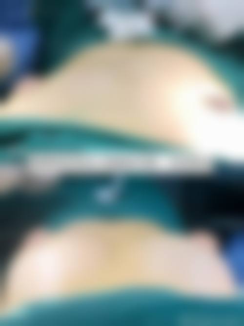 隆胸后多久能用力抓？3-6个月恢复关键期，假体/自体脂肪差异大！