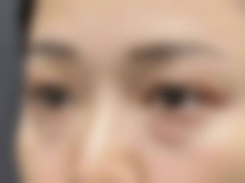 哪些人群在评估中更可能被建议考虑重度眼袋消除方法？