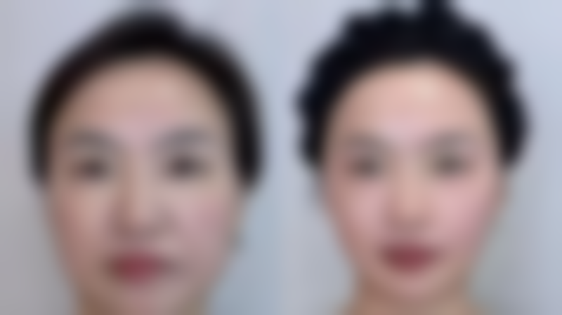 黄斑疤痕形成的原因是什么?在什么情况下会被关注