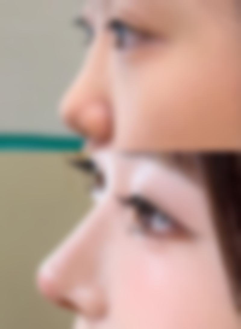 隆鼻打针能维持多久?看材料说话