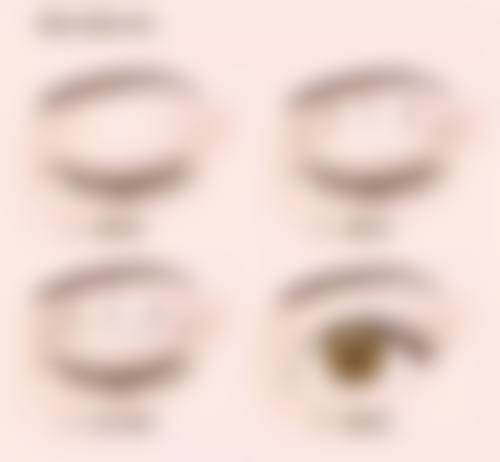 定点定位双眼皮能修复到以前的样子吗？