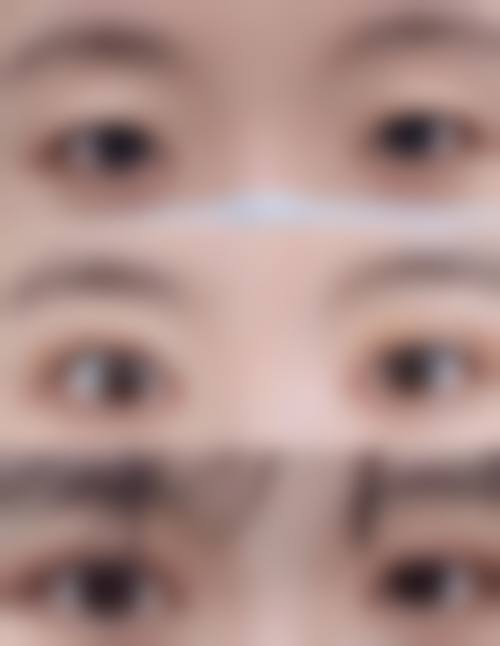 定点定位双眼皮的价格是多少？