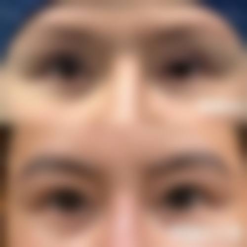 怎么判断我是否适合眼袋手术？综合评估，精细判断