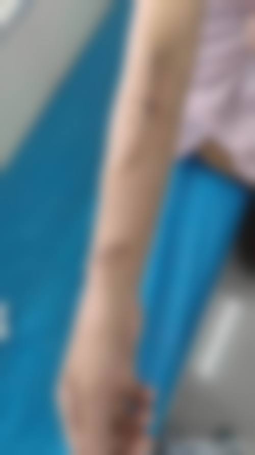 手术治疗能完全改善小女孩额头重度疤痕吗？具有影响力实例来证明！