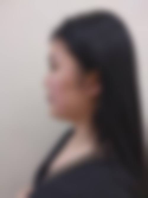 个人修复情况怎样左右隆鼻后鼻子通气时长?