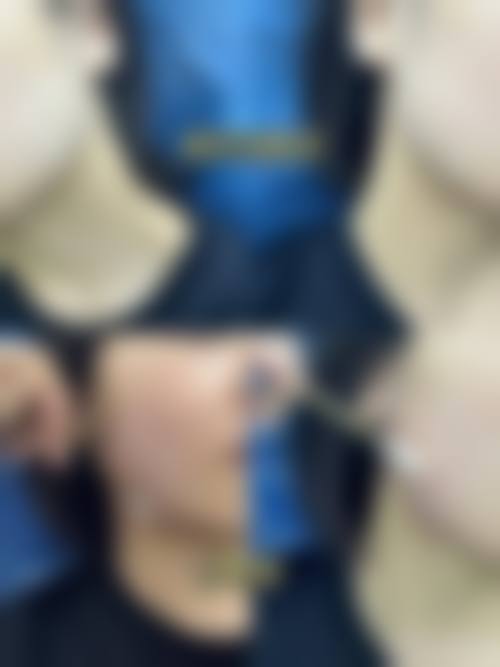 瘦脸针100单位和200单位有什么区别？剂量大成效更显著？