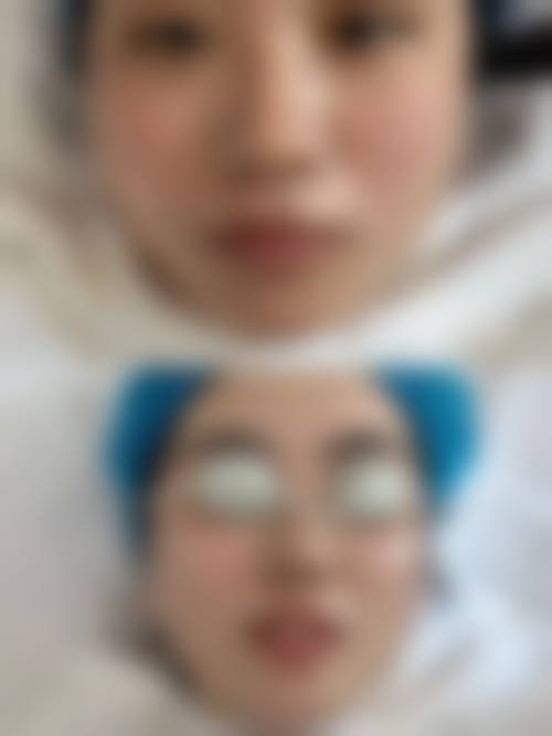 内吸眼袋修复常见疑问解答：帮你避开修复期的坑