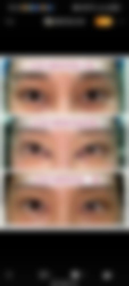 做完内吸眼袋多久能恢复？1-2周消肿1-3个月痊愈！影响恢复的关键因素揭秘