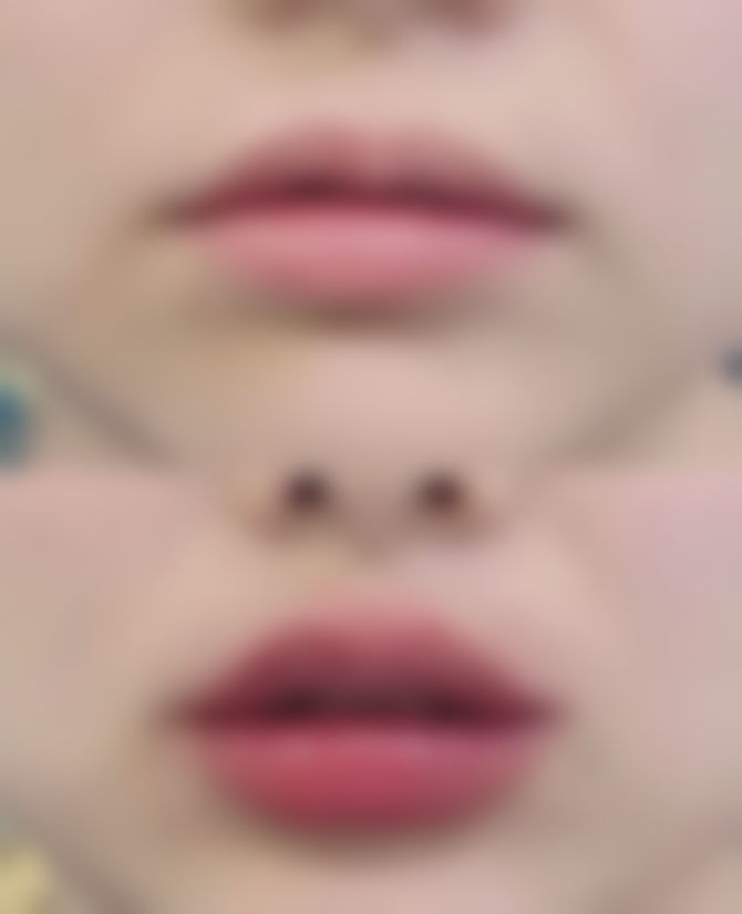 个人体质对阴道紧缩术成效维持时间的作用